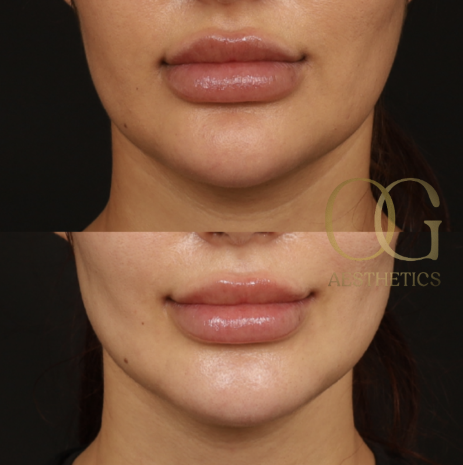 Chin Augmentation Before & After Gallery - Patient 164468 - Image 3