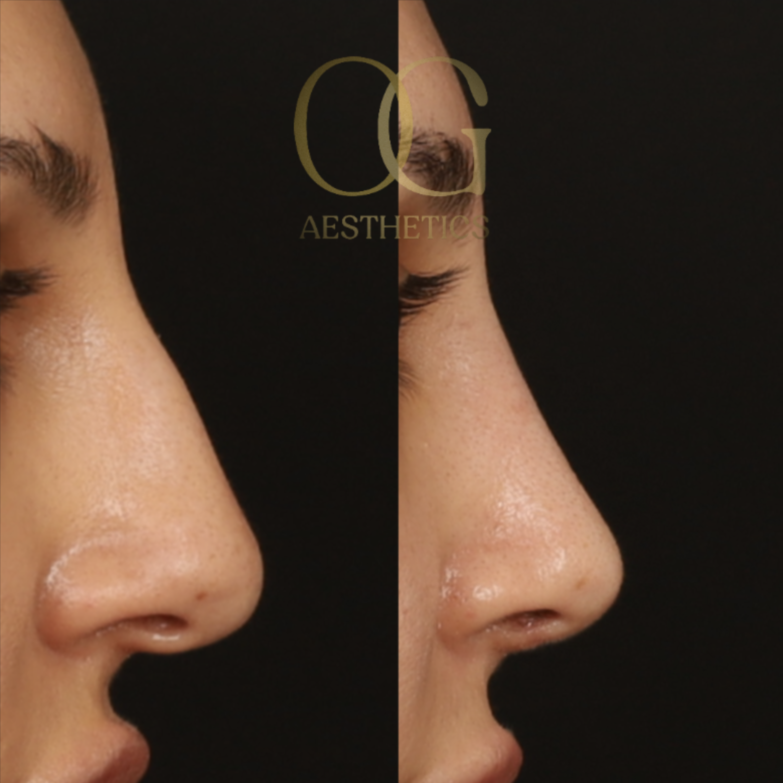 Rhinoplasty Before & After Gallery - Patient 308648 - Image 1
