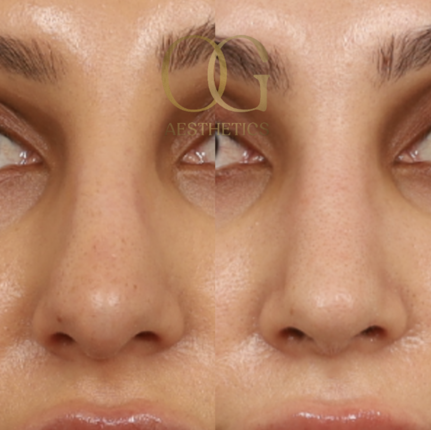 Rhinoplasty Before & After Gallery - Patient 308648 - Image 4