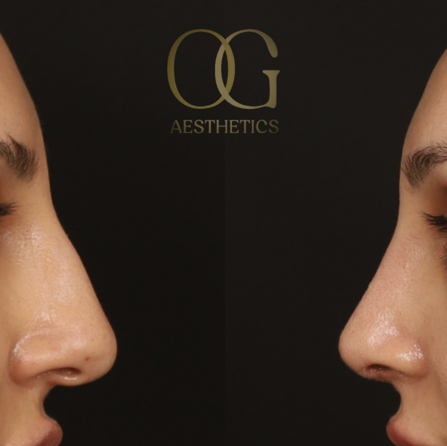 Rhinoplasty Before & After Gallery - Patient 308648 - Image 3