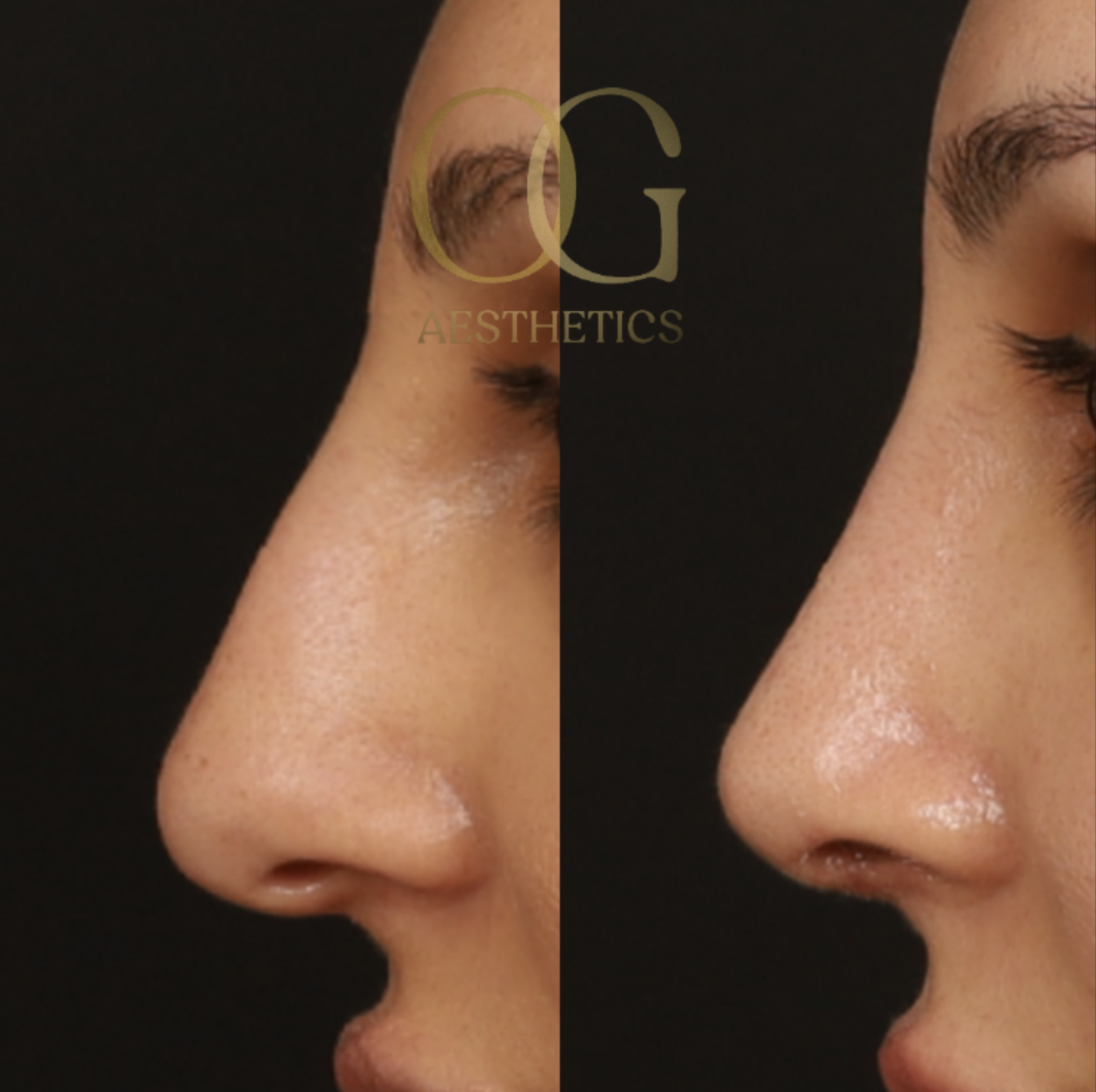Rhinoplasty Before & After Gallery - Patient 308648 - Image 2