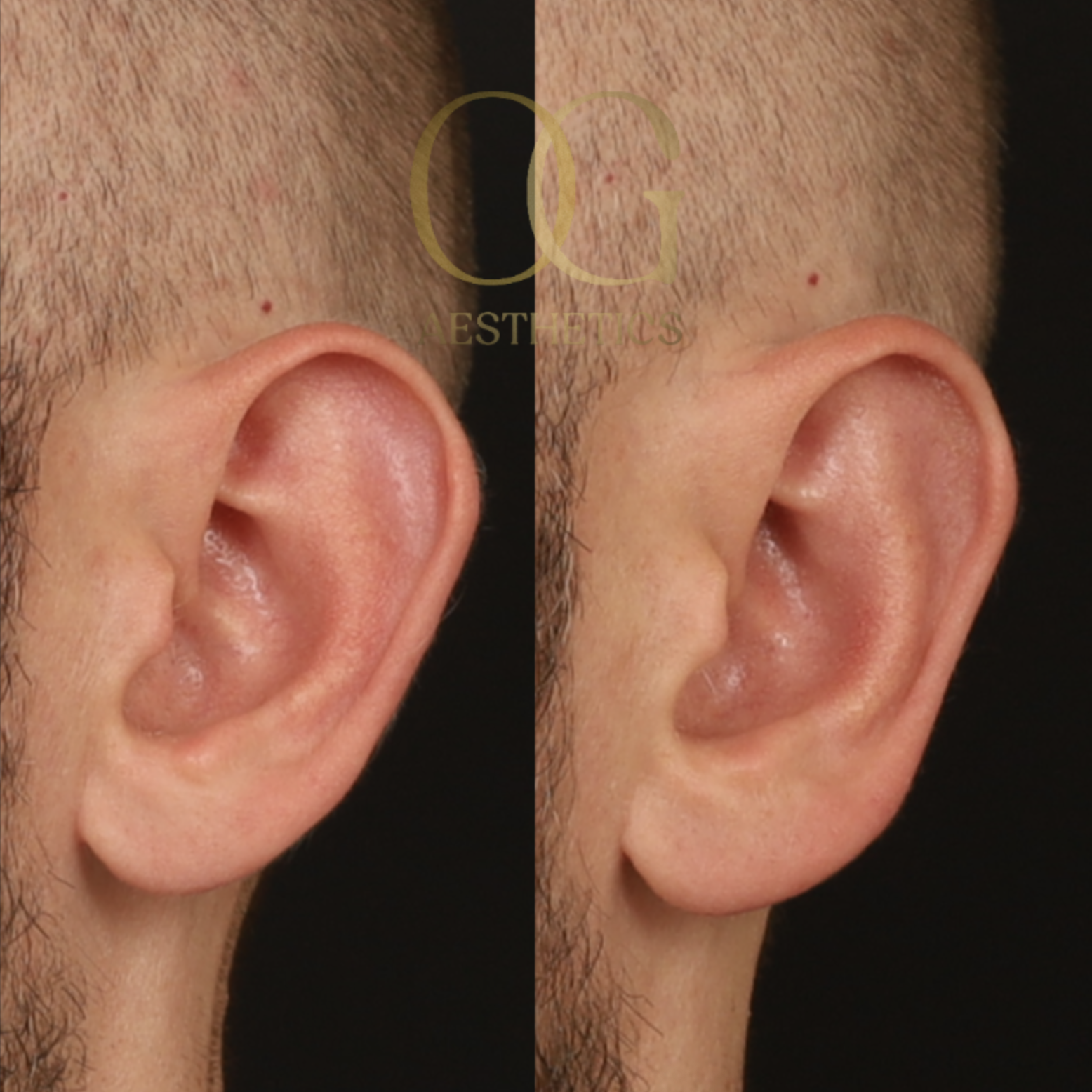 Otoplasty Before & After Gallery - Patient 327807 - Image 2