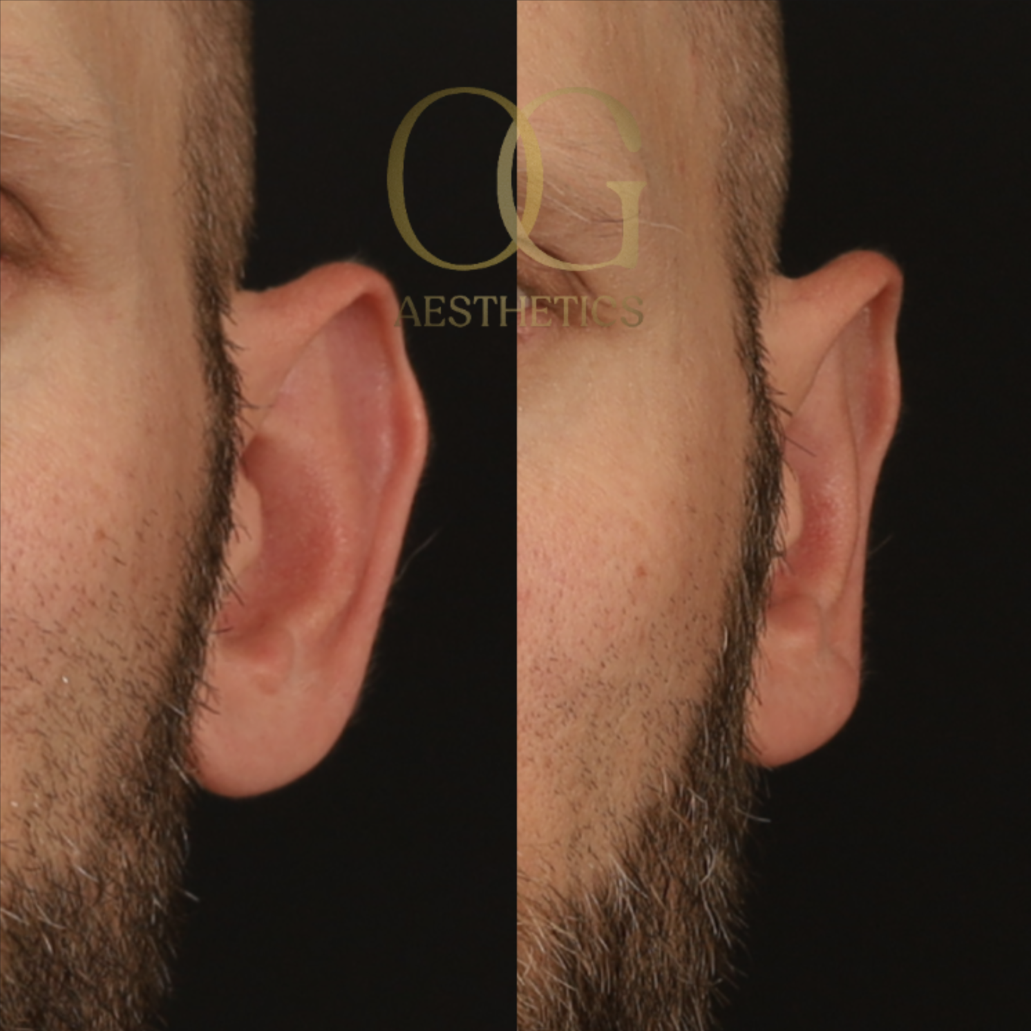 Otoplasty Before & After Gallery - Patient 327807 - Image 1