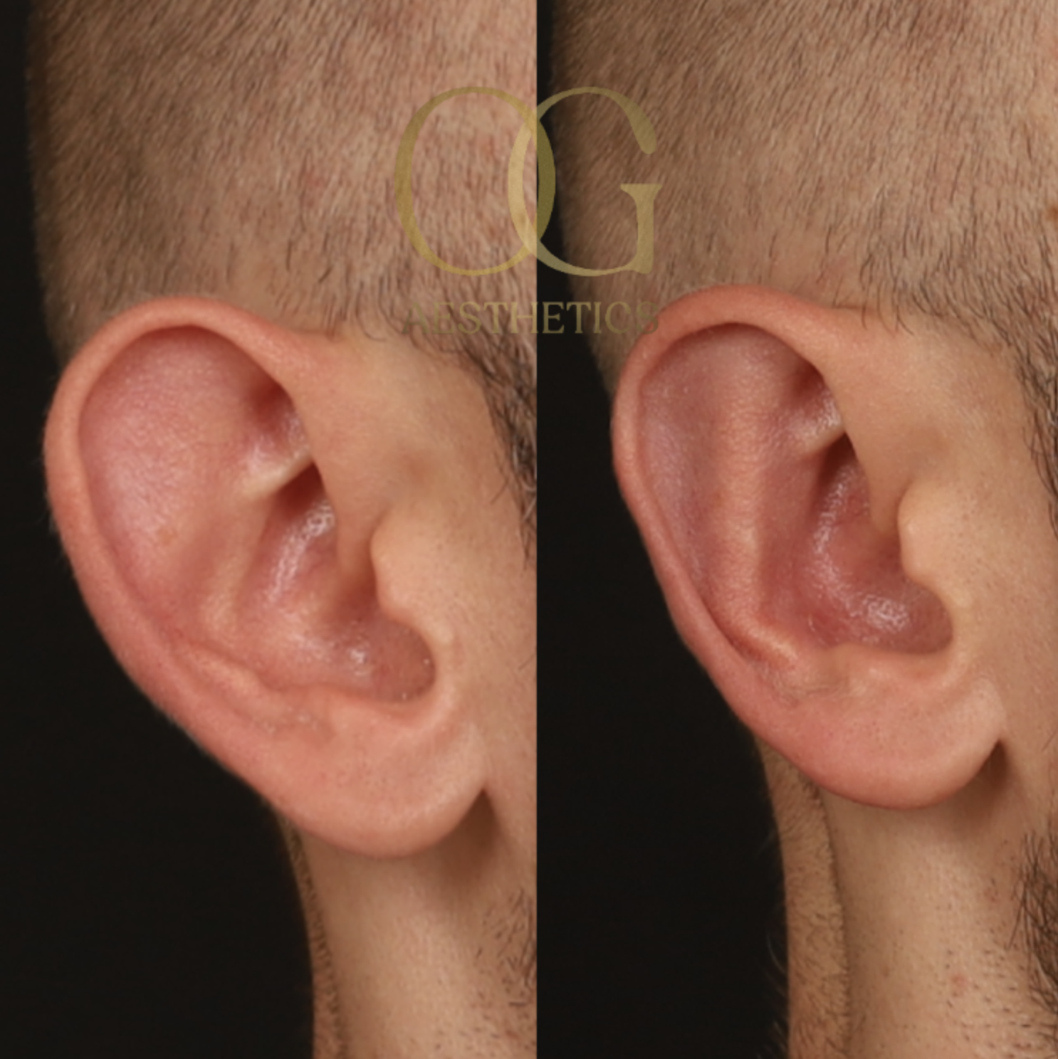 Otoplasty Before & After Gallery - Patient 327807 - Image 5