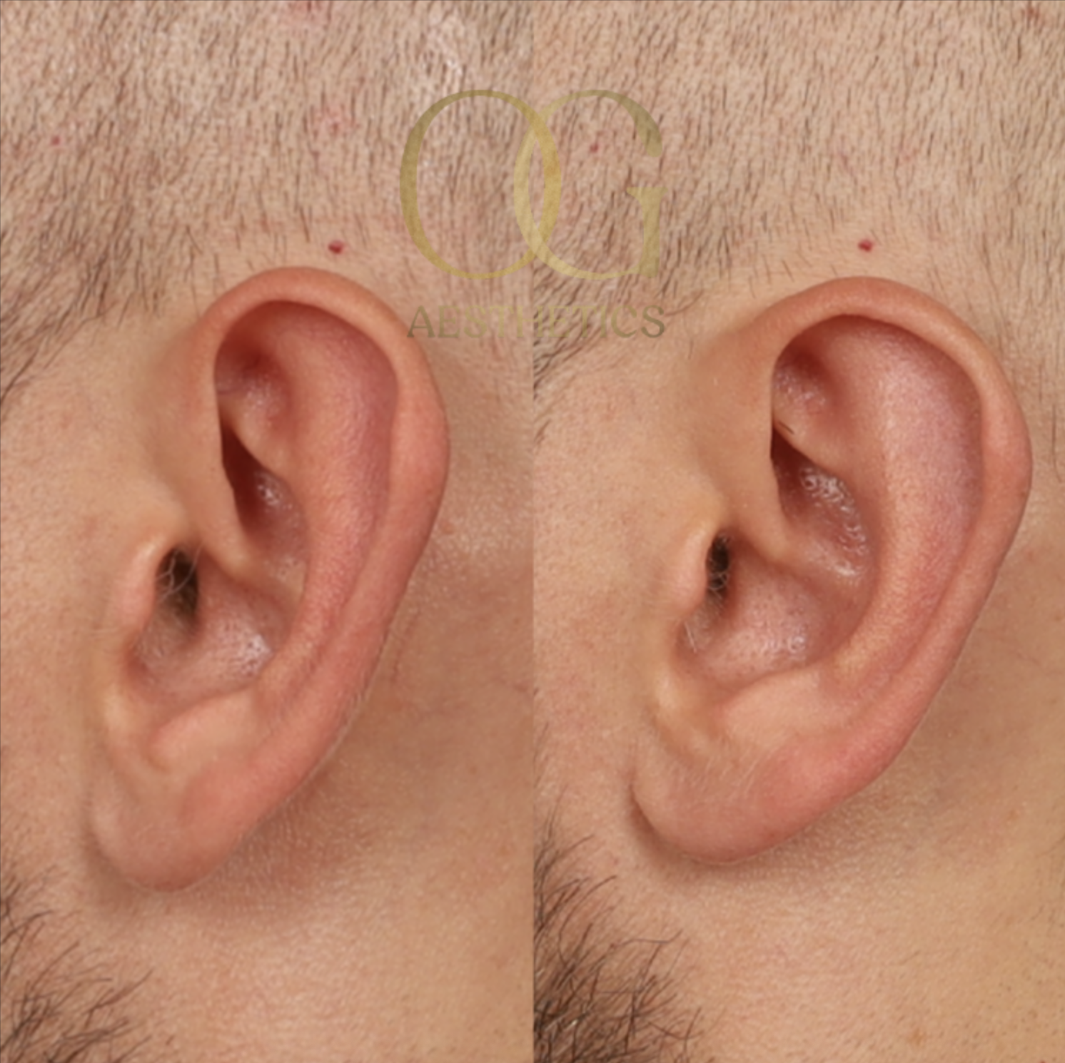 Otoplasty Before & After Gallery - Patient 327807 - Image 3