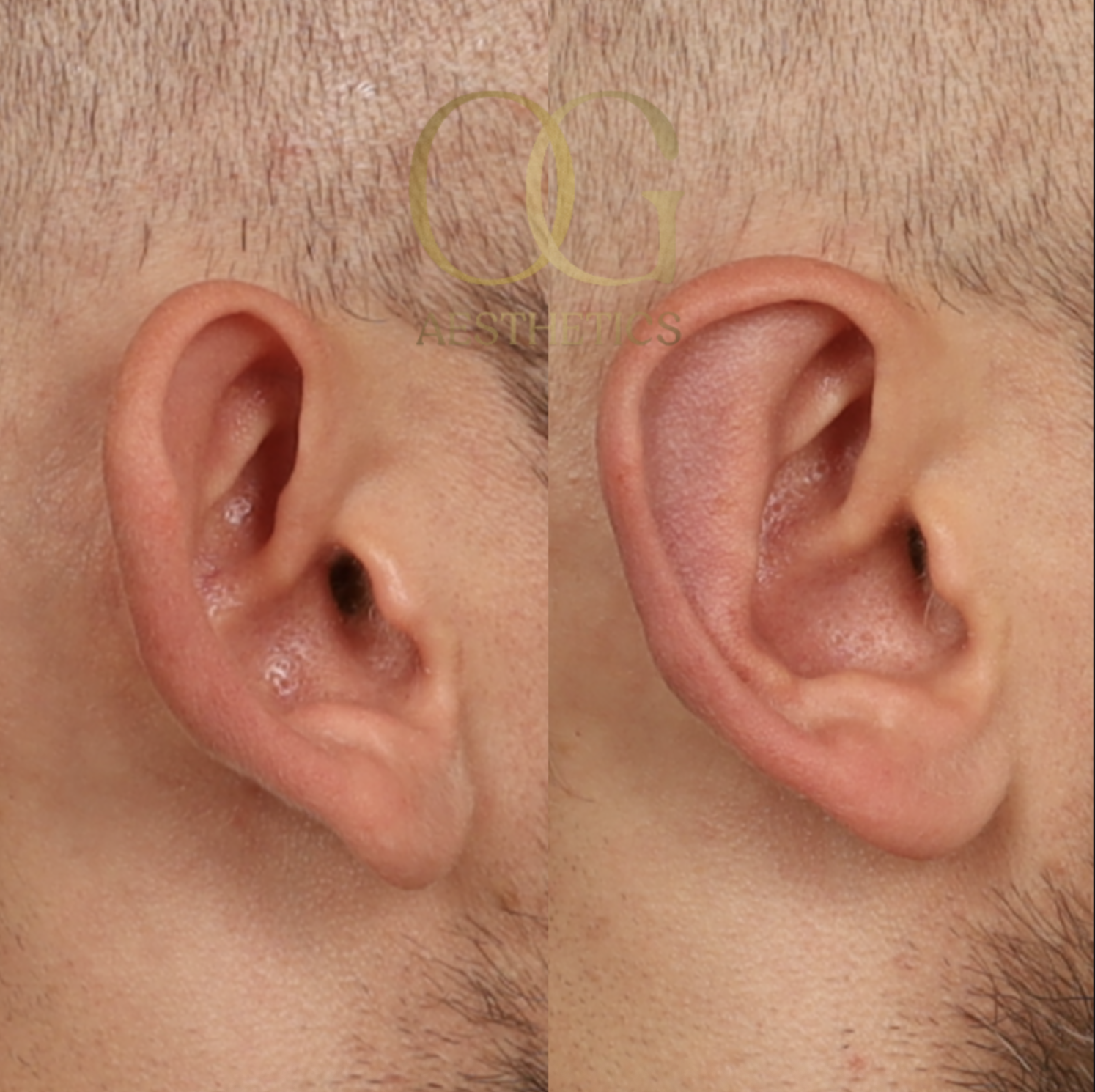 Otoplasty Before & After Gallery - Patient 327807 - Image 6