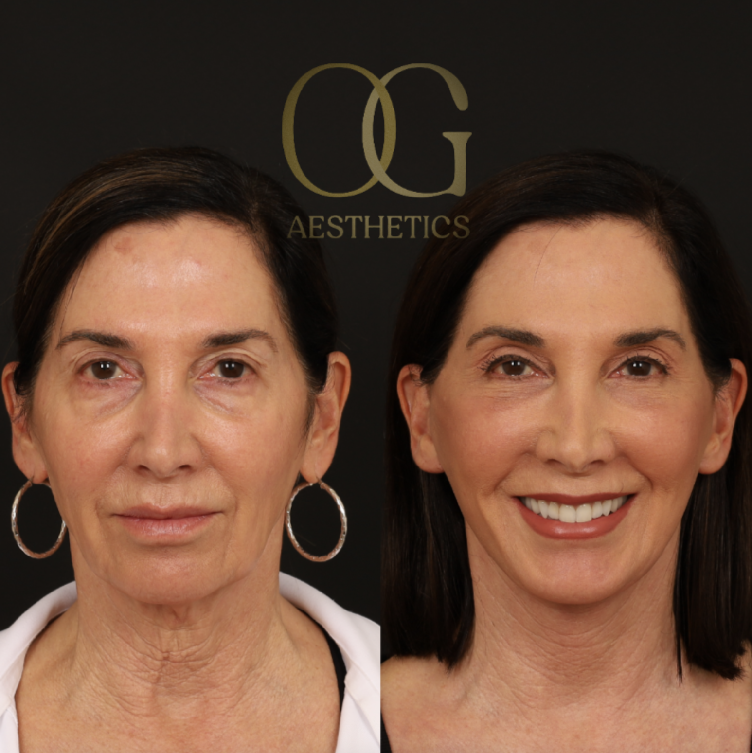 Neck Lift Before & After Gallery - Patient 421818 - Image 2