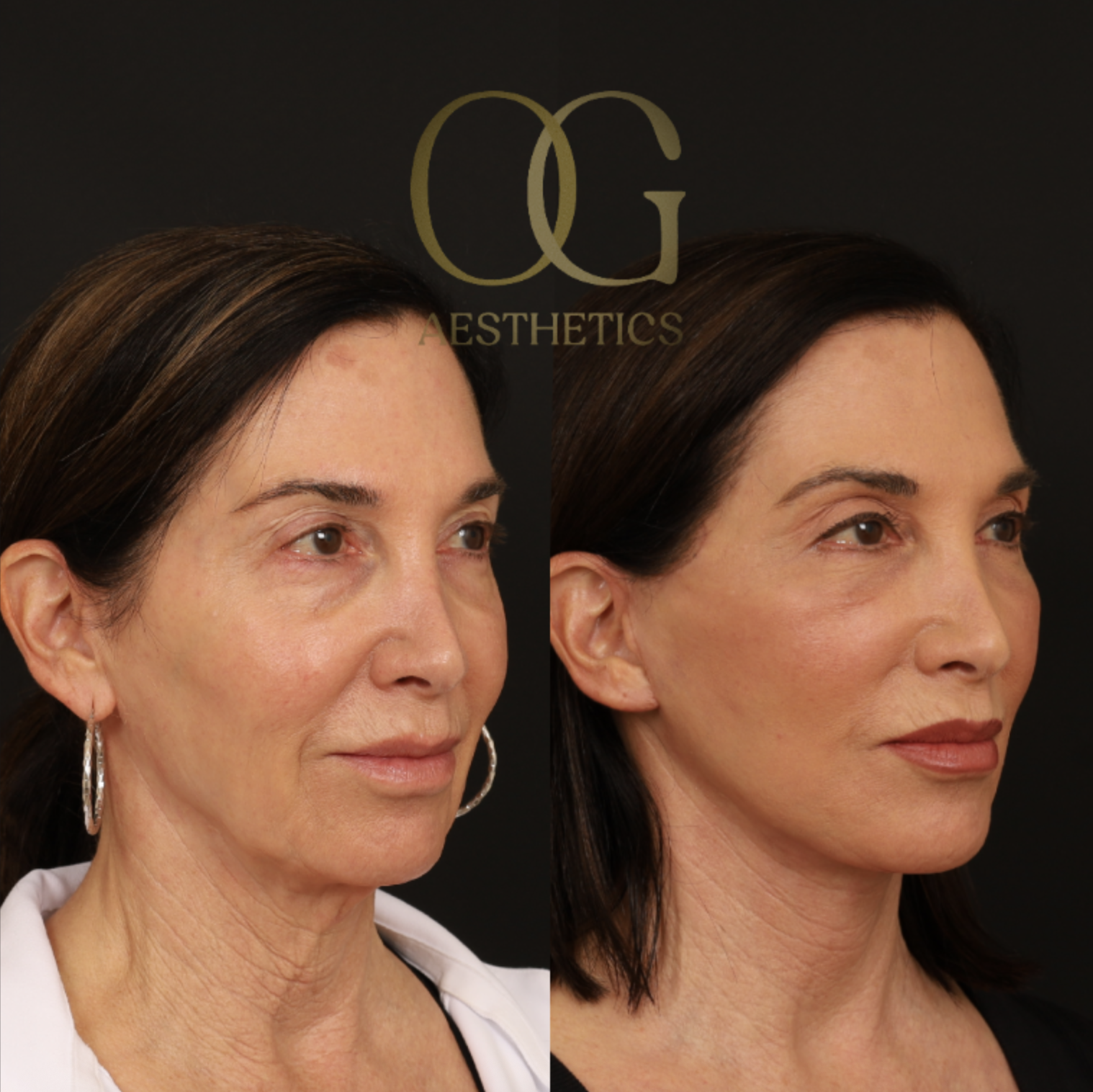 Neck Lift Before & After Gallery - Patient 421818 - Image 3