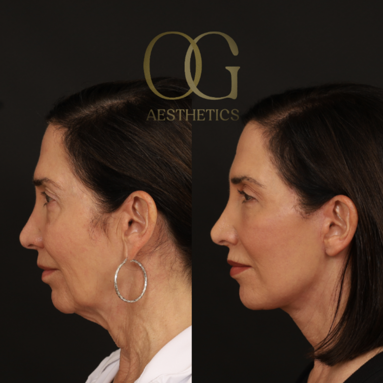 Neck Lift Before & After Gallery - Patient 421818 - Image 6