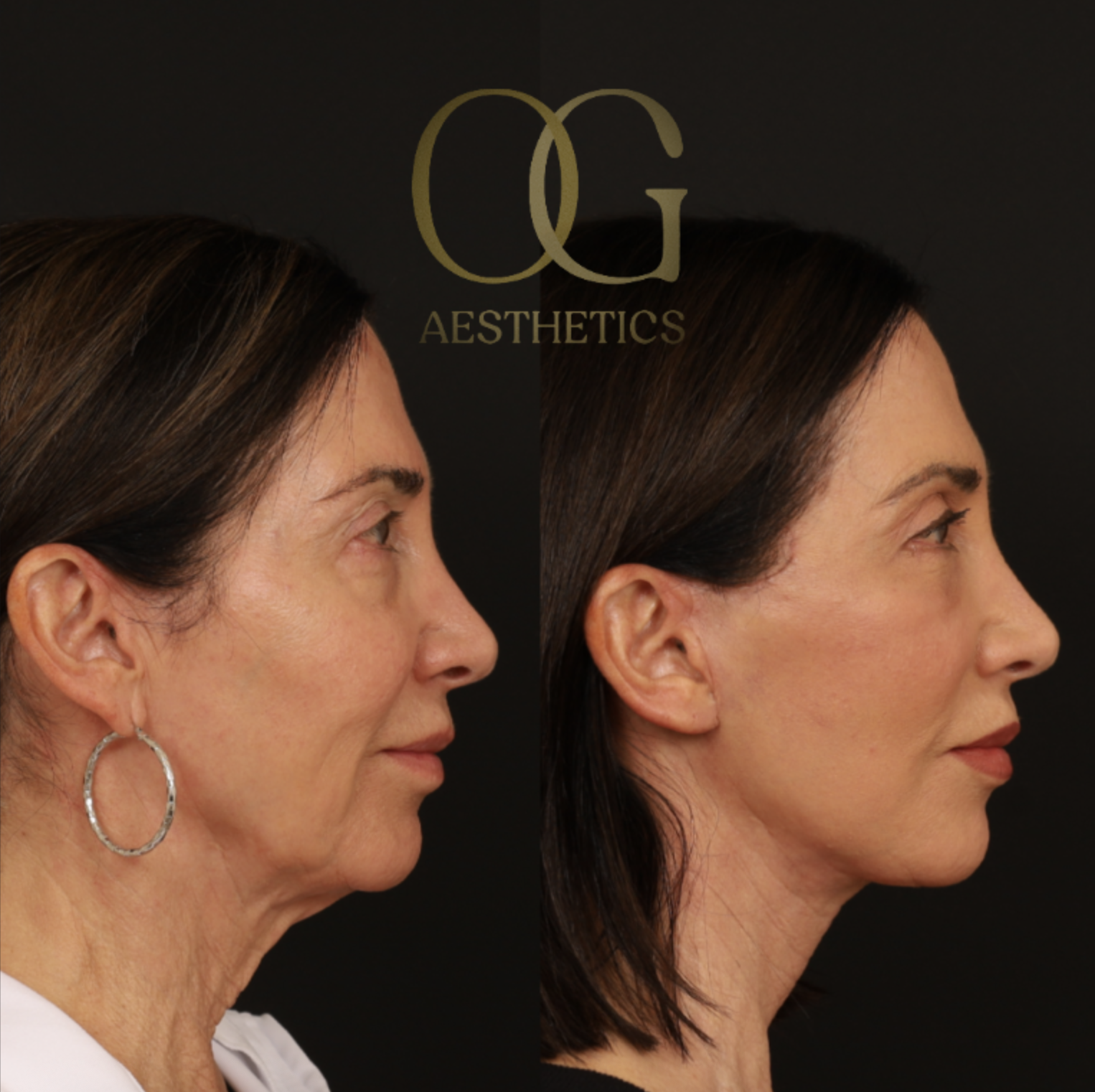 Neck Lift Before & After Gallery - Patient 421818 - Image 4