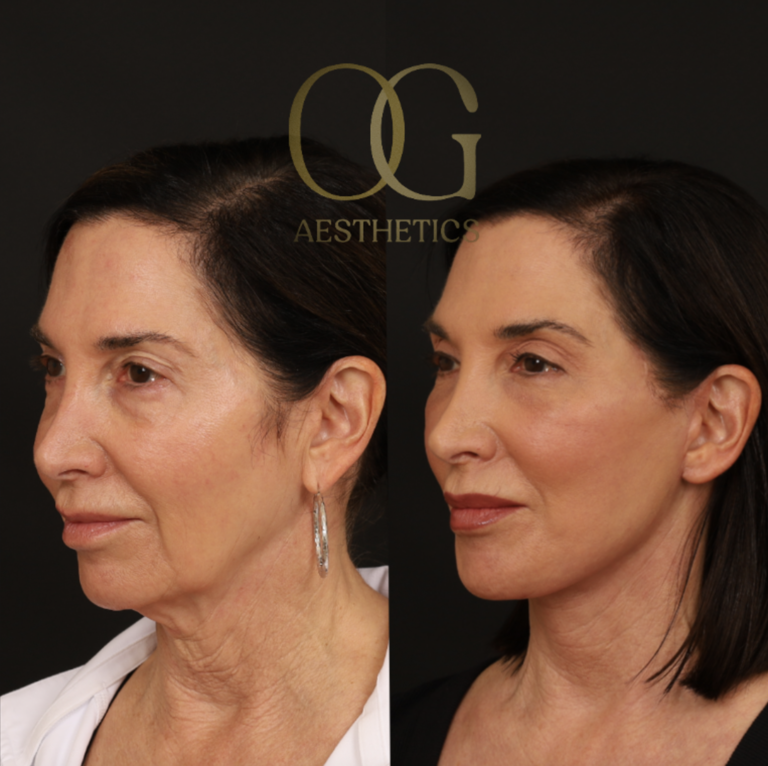 Neck Lift Before & After Gallery - Patient 421818 - Image 5