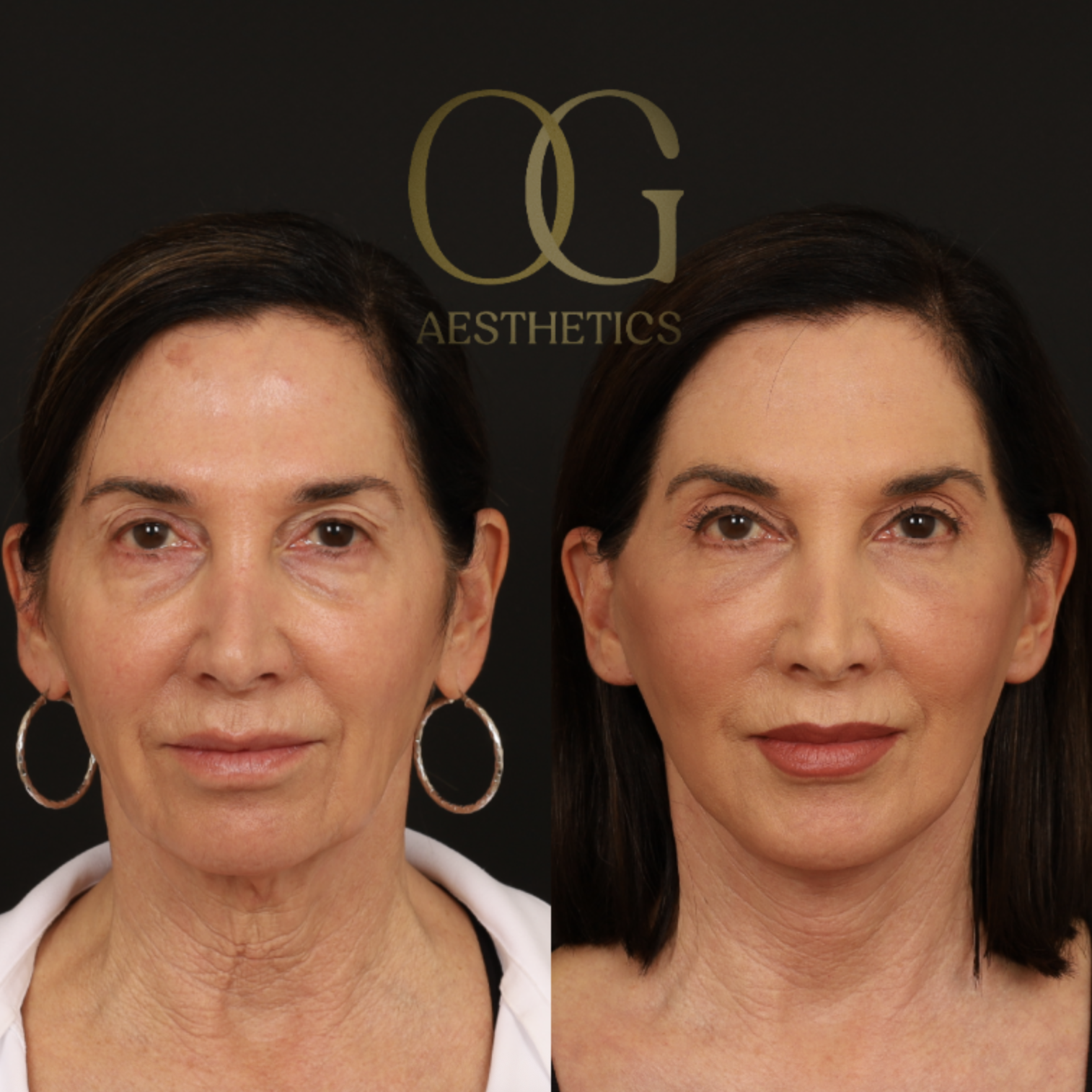 Neck Lift Before & After Gallery - Patient 421818 - Image 1