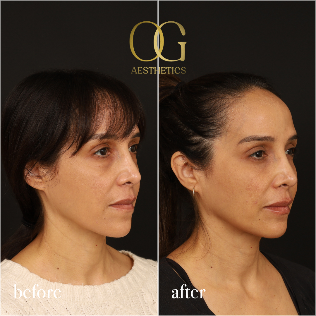 Blepharoplasty Before & After Gallery - Patient 211472 - Image 4
