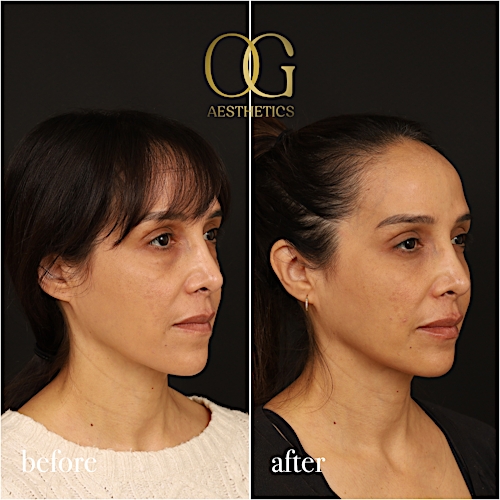Blepharoplasty Before & After Gallery - Patient 211472 - Image 4