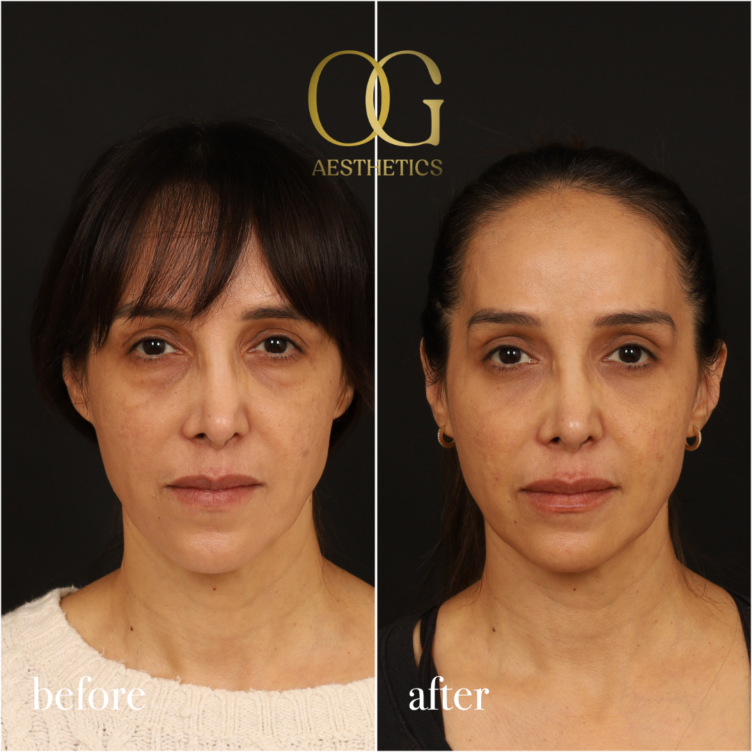 Blepharoplasty Before & After Gallery - Patient 211472 - Image 2