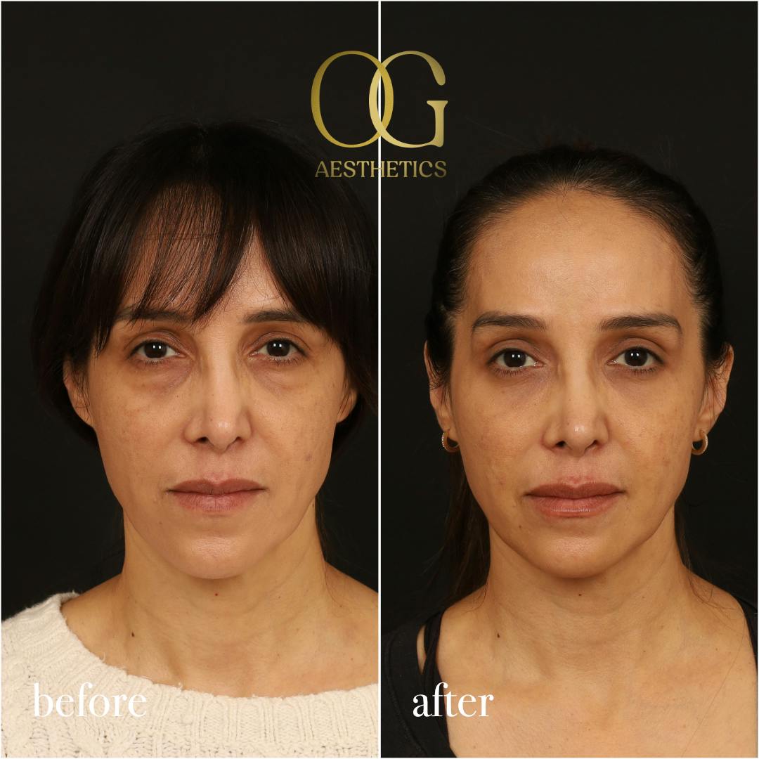 Blepharoplasty Before & After Gallery - Patient 211472 - Image 2