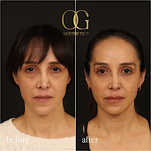 Blepharoplasty Before & After Gallery - Patient 211472 - Image 2