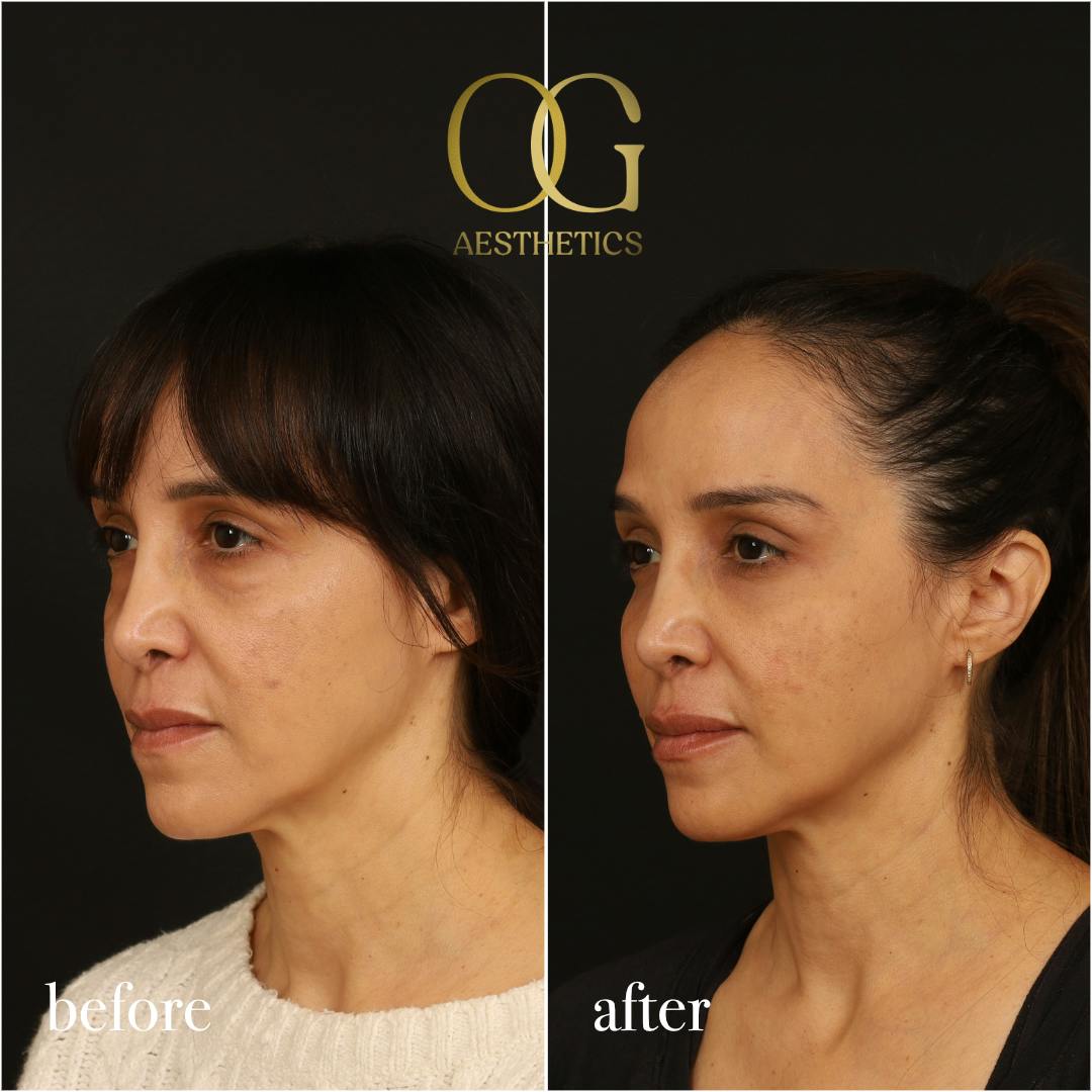 Blepharoplasty Before & After Gallery - Patient 211472 - Image 6