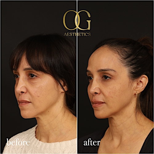 Blepharoplasty Before & After Gallery - Patient 211472 - Image 6