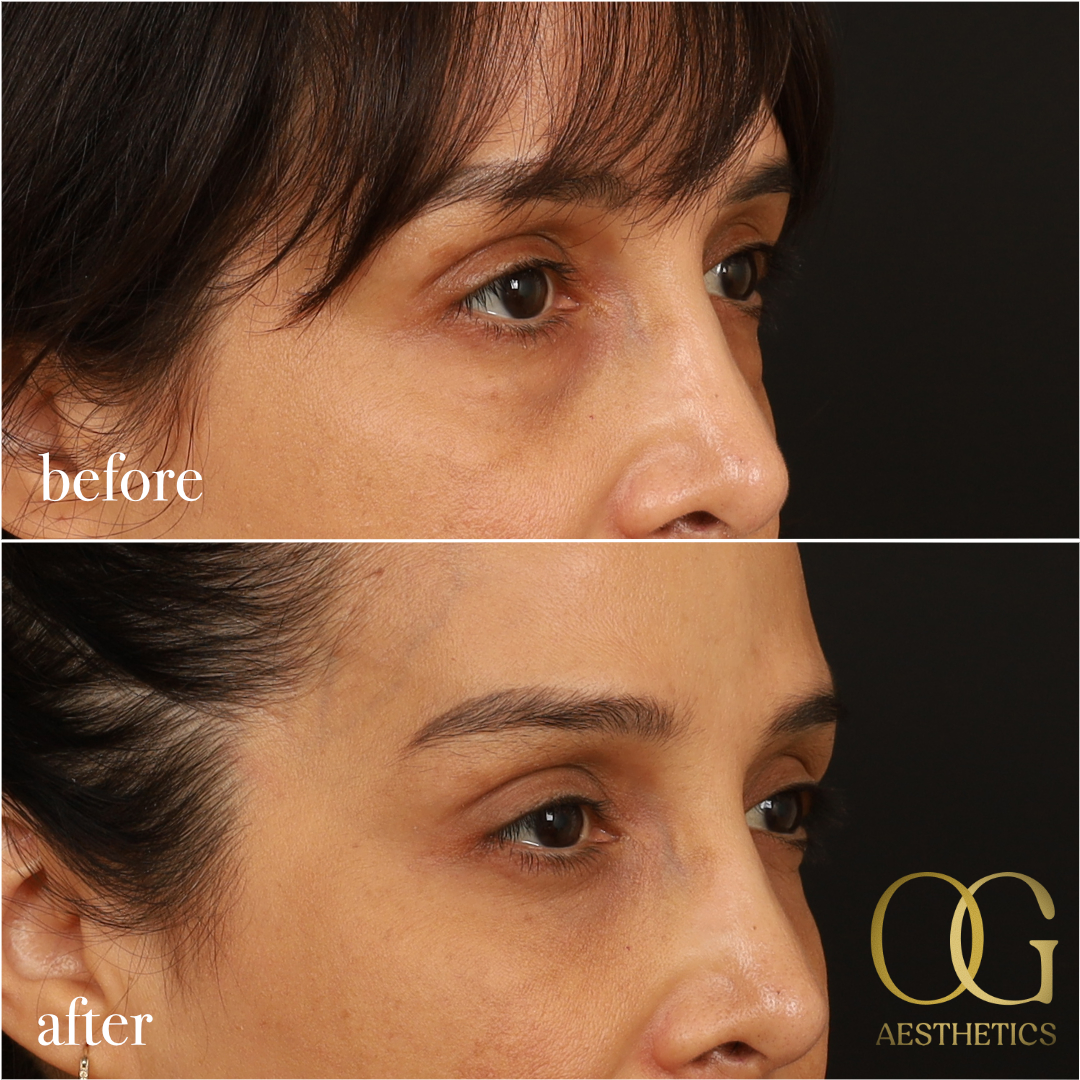 Blepharoplasty Before & After Gallery - Patient 211472 - Image 10