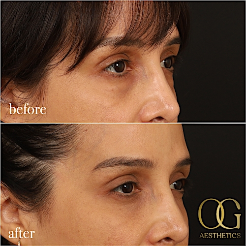 Blepharoplasty Before & After Gallery - Patient 211472 - Image 10