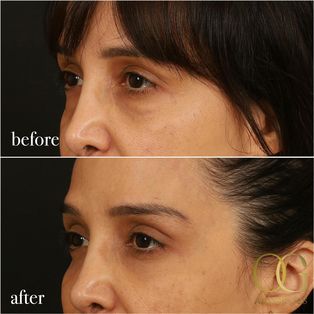 Blepharoplasty Before & After Gallery - Patient 211472 - Image 11