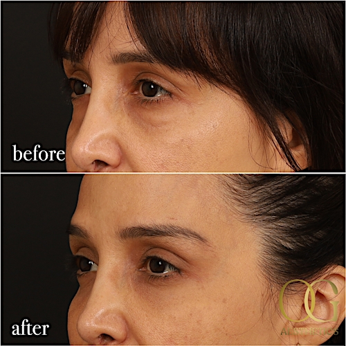 Blepharoplasty Before & After Gallery - Patient 211472 - Image 11