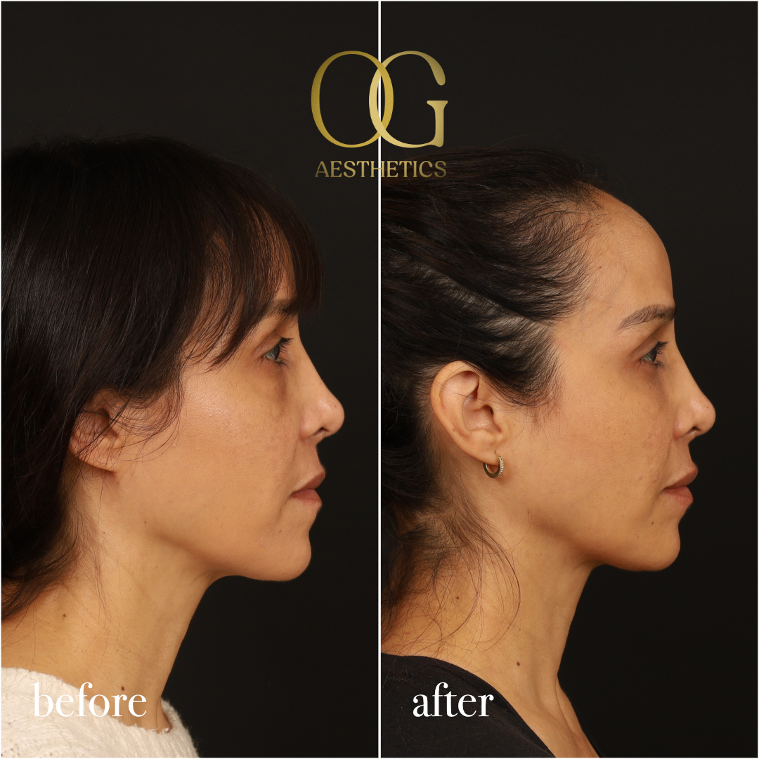 Blepharoplasty Before & After Gallery - Patient 211472 - Image 5