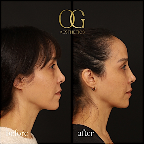 Blepharoplasty Before & After Gallery - Patient 211472 - Image 5