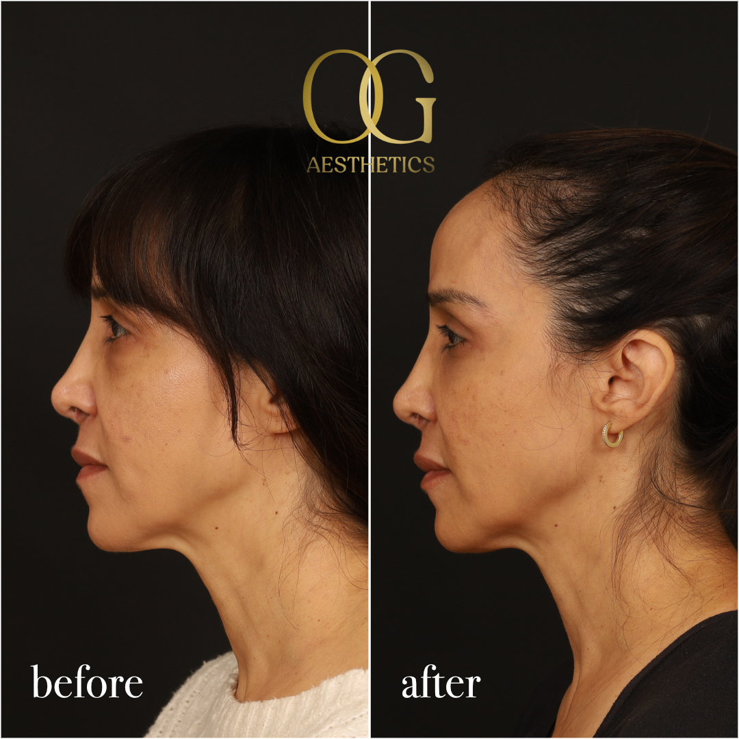 Blepharoplasty Before & After Gallery - Patient 211472 - Image 7
