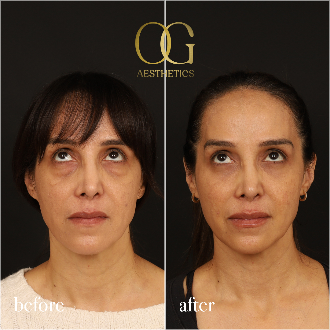 Blepharoplasty Before & After Gallery - Patient 211472 - Image 3