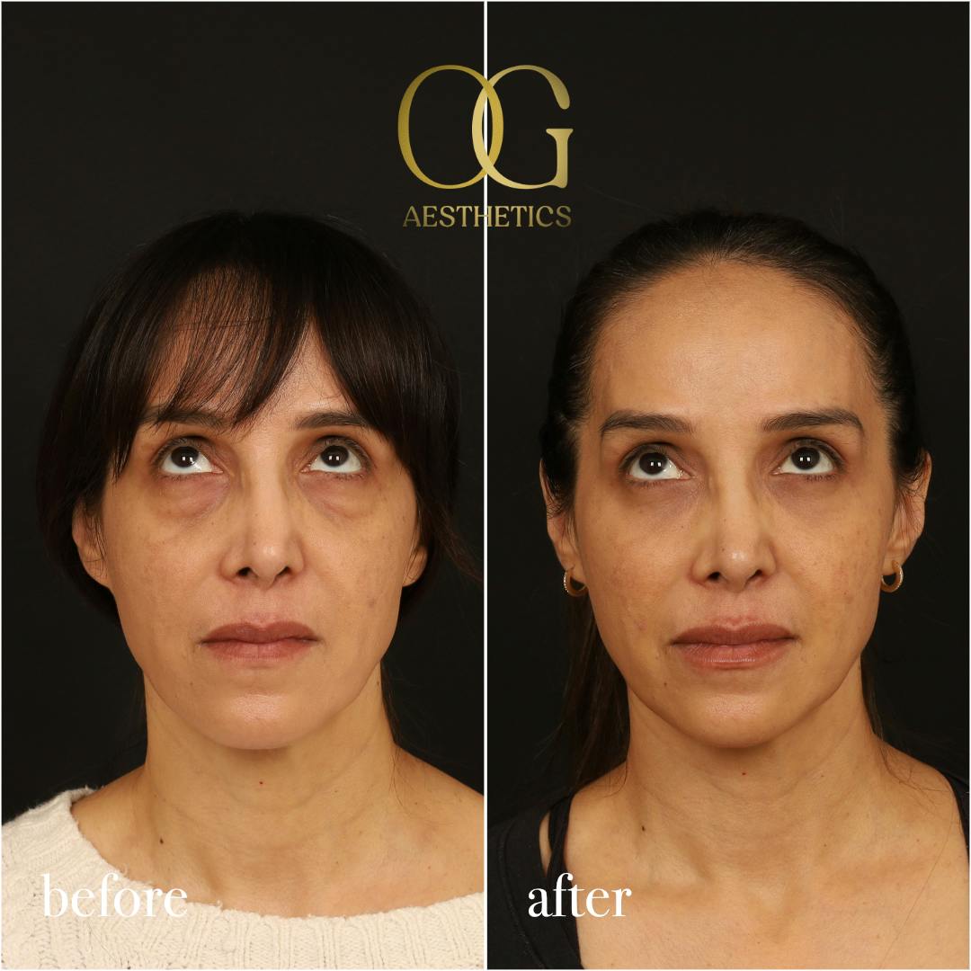 Blepharoplasty Before & After Gallery - Patient 211472 - Image 3