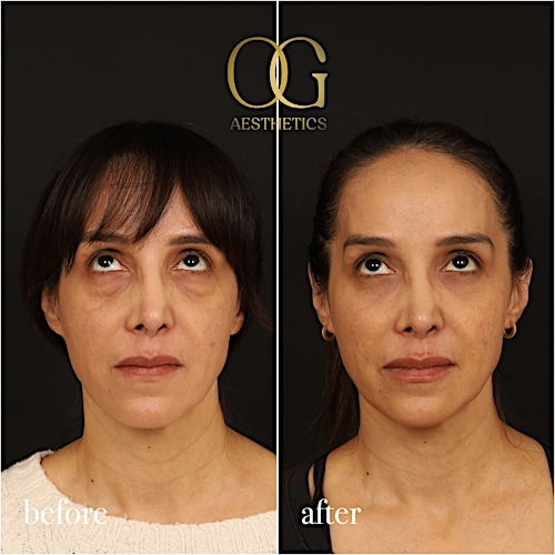 Blepharoplasty Before & After Gallery - Patient 211472 - Image 3