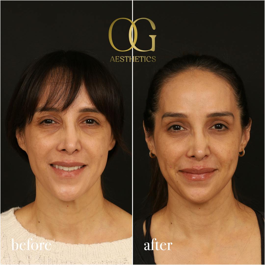 Blepharoplasty Before & After Gallery - Patient 211472 - Image 1