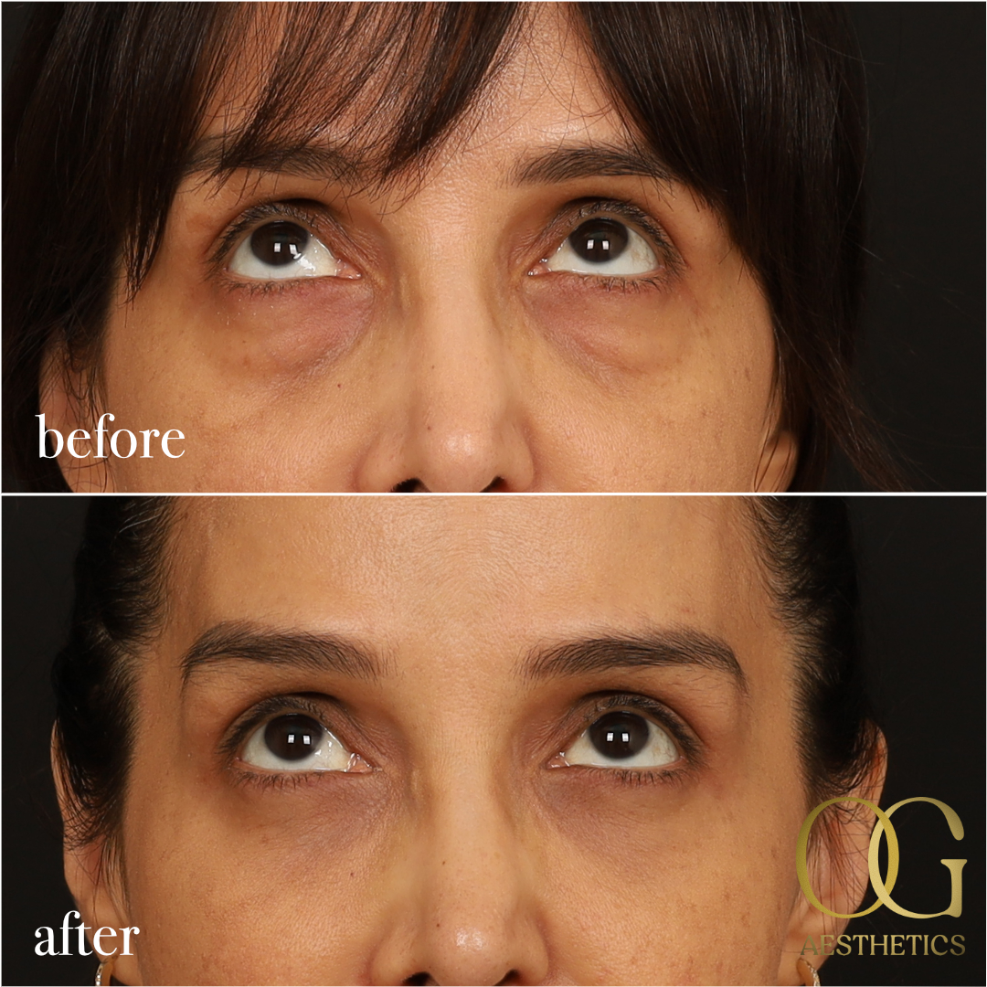 Blepharoplasty Before & After Gallery - Patient 211472 - Image 12