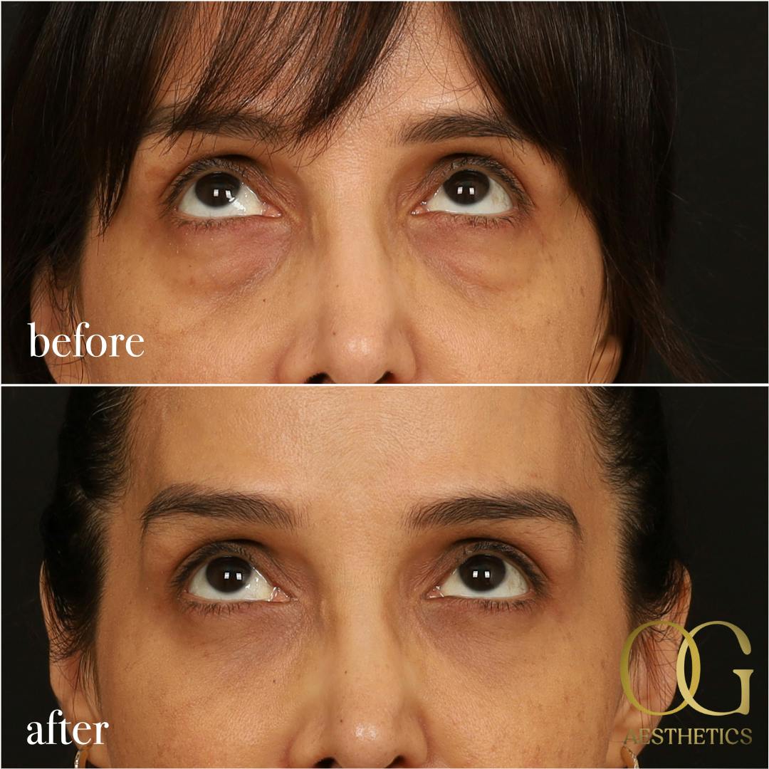 Blepharoplasty Before & After Gallery - Patient 211472 - Image 12
