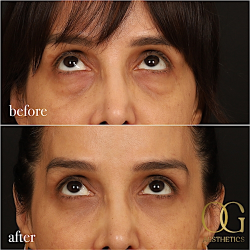 Blepharoplasty Before & After Gallery - Patient 211472 - Image 12