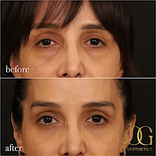 Blepharoplasty Before & After Gallery - Patient 211472 - Image 8
