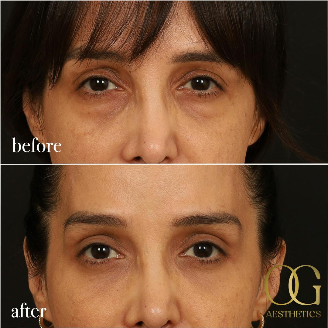 Blepharoplasty Before & After Gallery - Patient 211472 - Image 9
