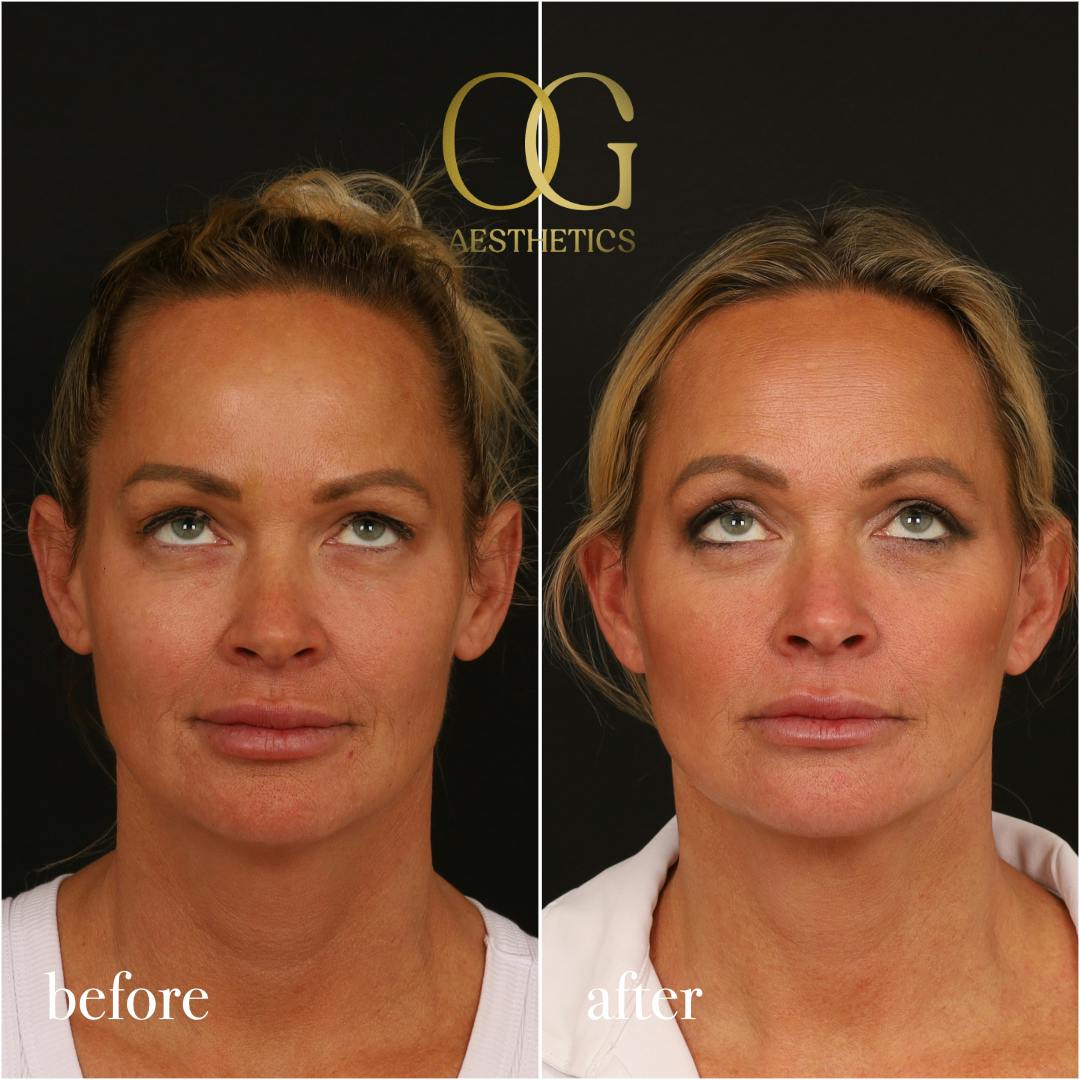 Blepharoplasty Before & After Gallery - Patient 242962 - Image 1