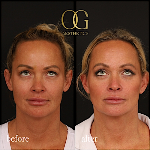 Blepharoplasty Before & After Gallery - Patient 242962 - Image 1