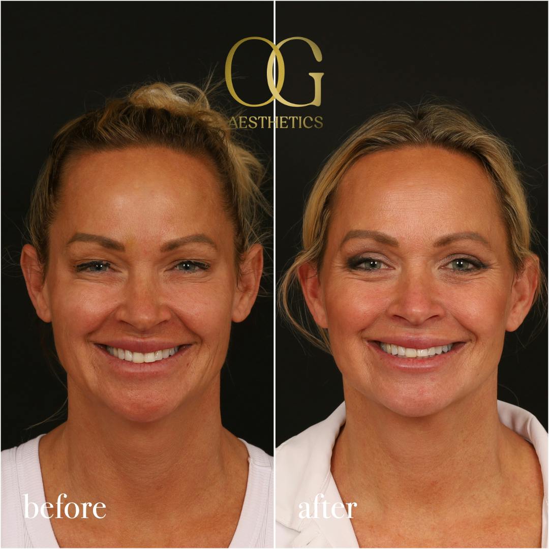 Blepharoplasty Before & After Gallery - Patient 242962 - Image 3