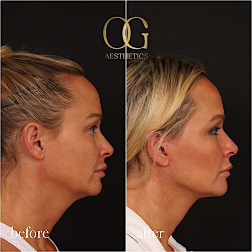 Blepharoplasty Before & After Gallery - Patient 242962 - Image 6