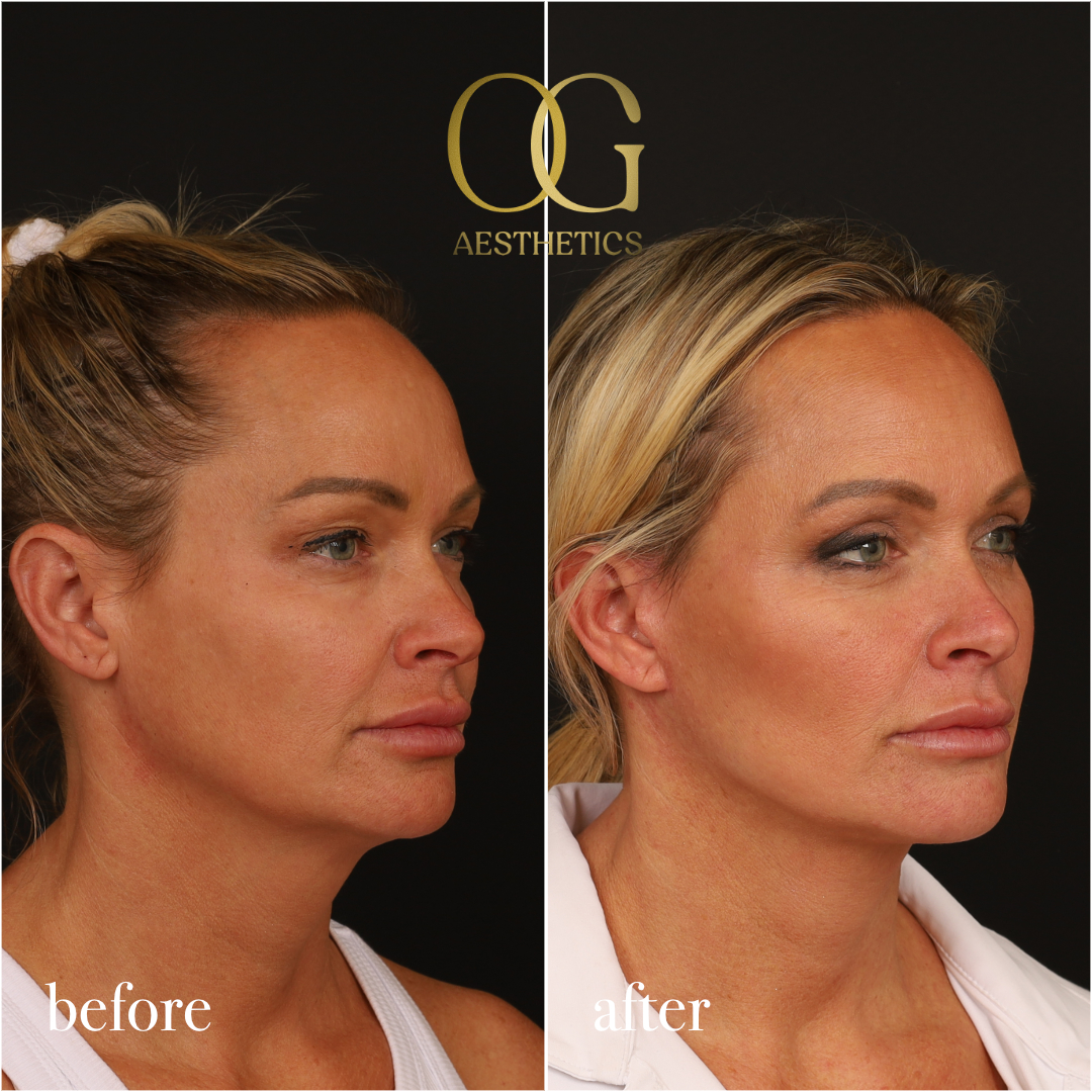 Blepharoplasty Before & After Gallery - Patient 242962 - Image 5