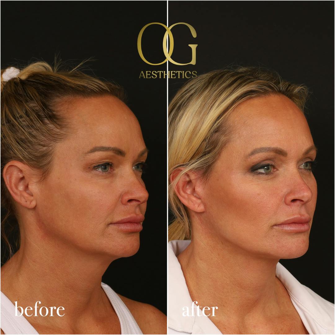 Blepharoplasty Before & After Gallery - Patient 242962 - Image 5