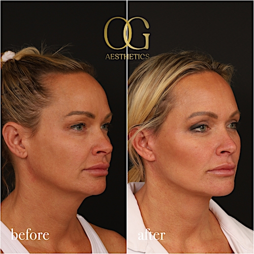 Blepharoplasty Before & After Gallery - Patient 242962 - Image 5