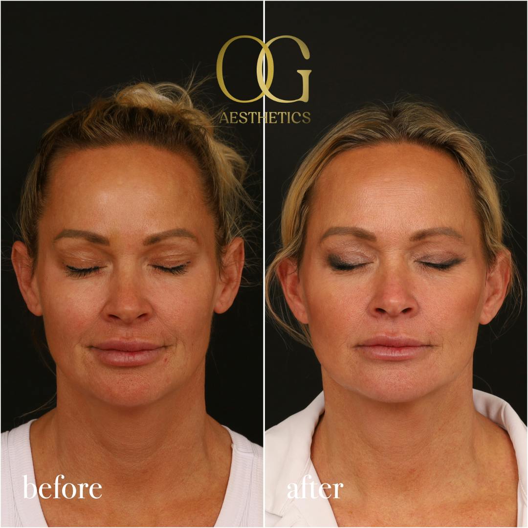 Blepharoplasty Before & After Gallery - Patient 242962 - Image 4