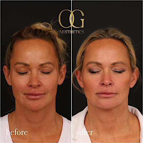 Blepharoplasty Before & After Gallery - Patient 242962 - Image 4