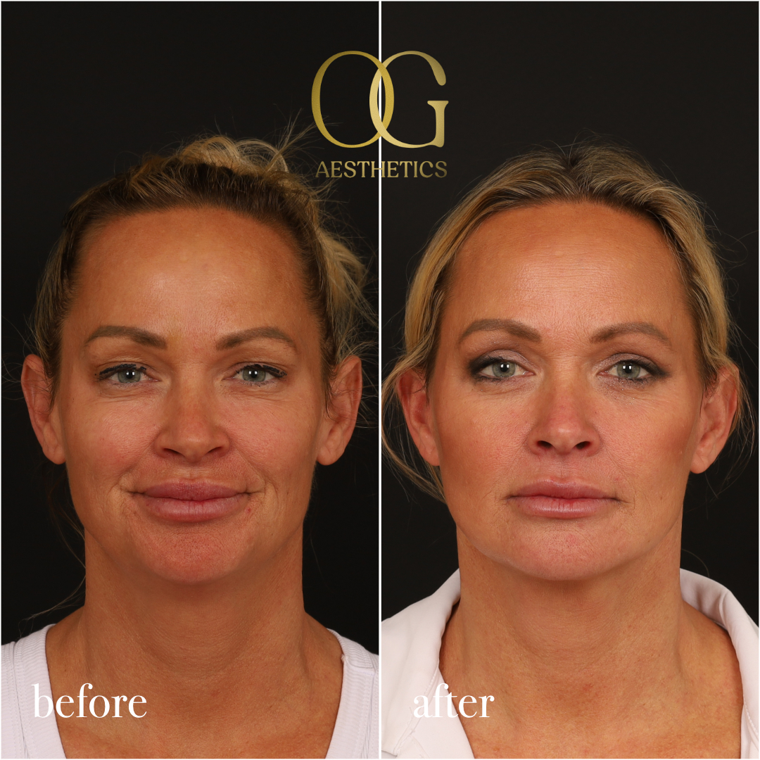 Blepharoplasty Before & After Gallery - Patient 242962 - Image 2
