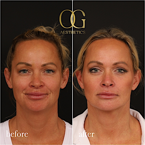 Blepharoplasty Before & After Gallery - Patient 242962 - Image 2